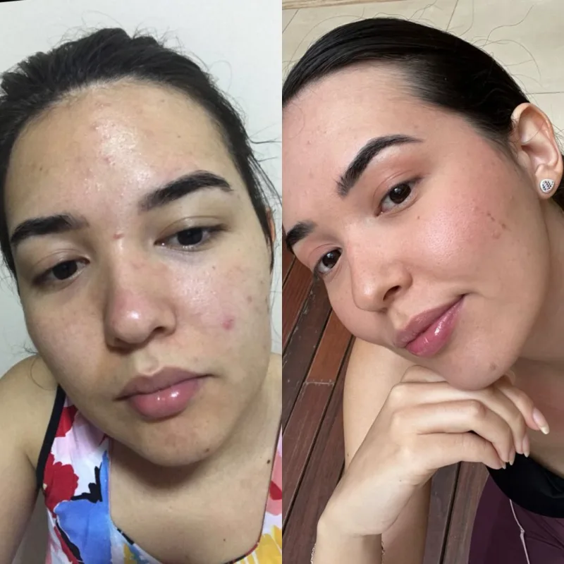 Antes e depois - resultado 1