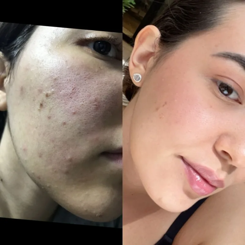 Antes e depois - resultado 2